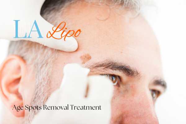 What Are the Most Effective Treatments for Age Spots South Kensington?