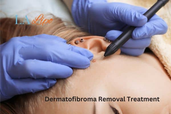 Dermatofibroma Removal Treatment South Kensington