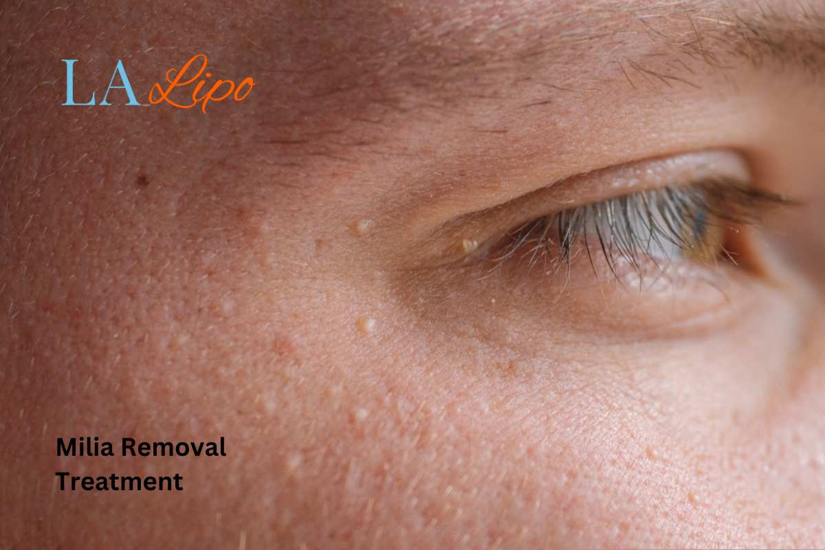 Cryopen Milia Removal: Is It the Easiest and Safest Option South Kensington?