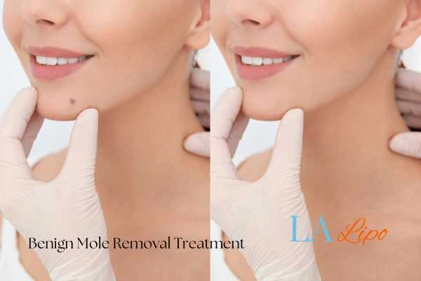 woman's before and after mole removal South Kensington results