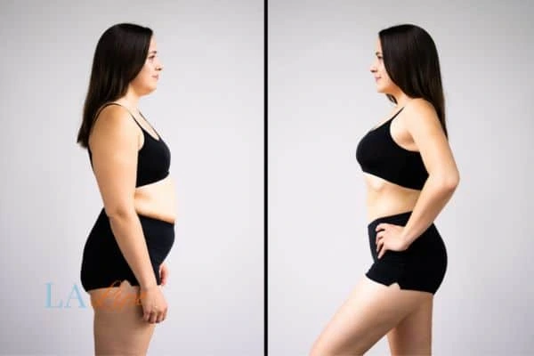 image of woman before and after results of LA-EMS Body Sculpting South Kensington to help treat Diastasis recti