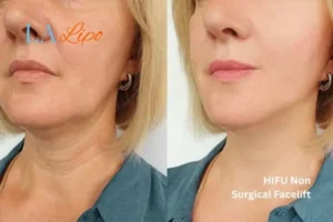 hi-fu for wrinkles South Kensington before and after results