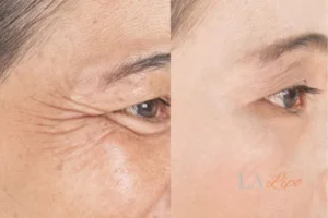 Before and after results of woman - HI-fu wrinkles reduction treatment South Kensington