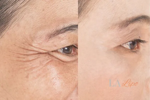 Before and after results of woman - HI-fu wrinkles reduction treatment South Kensington