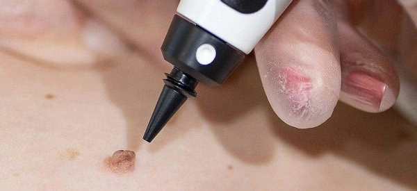 skin tag removal using cryopen South Kensington