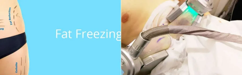 Fat freezing South Kensington on multiple areas of the body