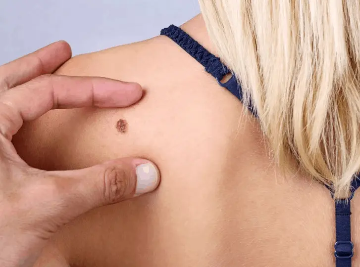 woman having mole removal South Kensington consultation before treatment.