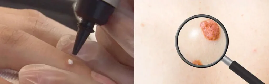 Cryopen for mole removal South Kensington - speak to our team today!
