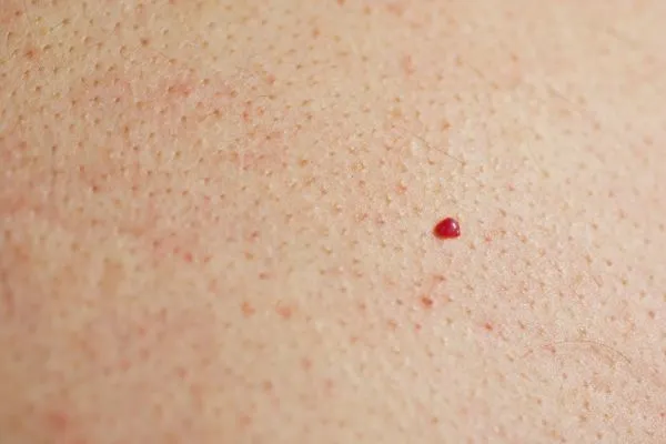 close up of a cherry angioma South Kensington