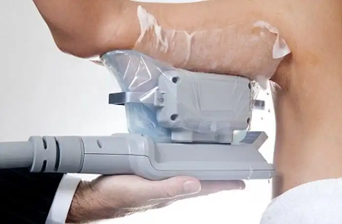 Picture of fat freezing South Kensington on the upper arms.