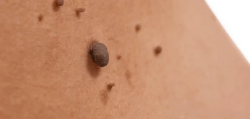 image of a skin tag South Kensington
