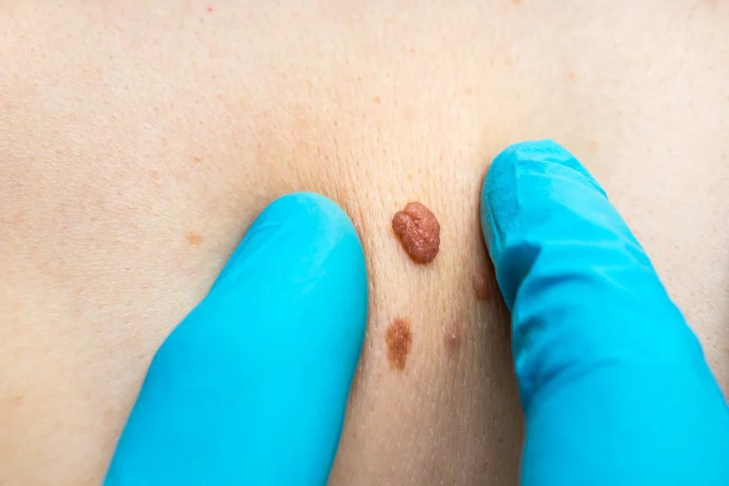 Consultant examining a skin tag South Kensington