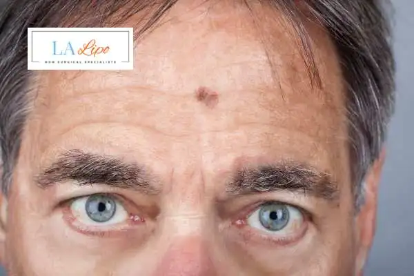 Solar Lentigo Removal South Kensington image of man with mark on his forehead