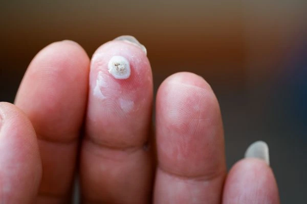 wart on person finger - cryotherapy to treat from LA LIPO South Kensington