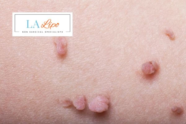 Does cryopen skin tag removal South Kensington hurt? Find out now call our team today!