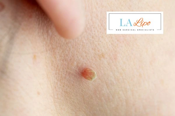 Book skin tag removal South Kensington today speak to our team now!