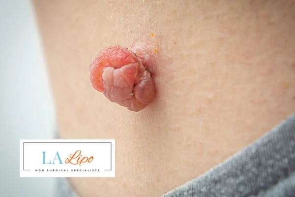 Interested in skin tag removal South Kensington? Concerned about the pain? Find out more today!