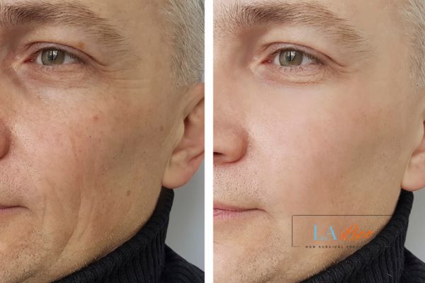 See the amazing results of Morpheus8 Treatment South Kensington!