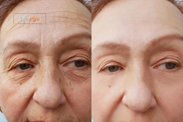 The powerful benefits of Morpheus8 Treatment South Kensington - Call Our team today!