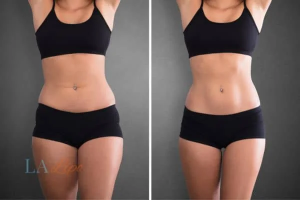 before and after results of non-surgical treatment to help a woman's body image and mental health South Kensington