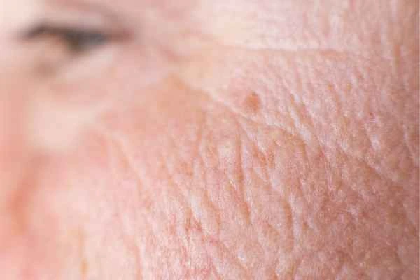close up picture of a woman's face showing an age spot South Kensington