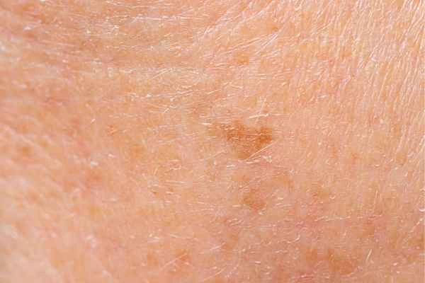 close up picture of age spots South Kensington