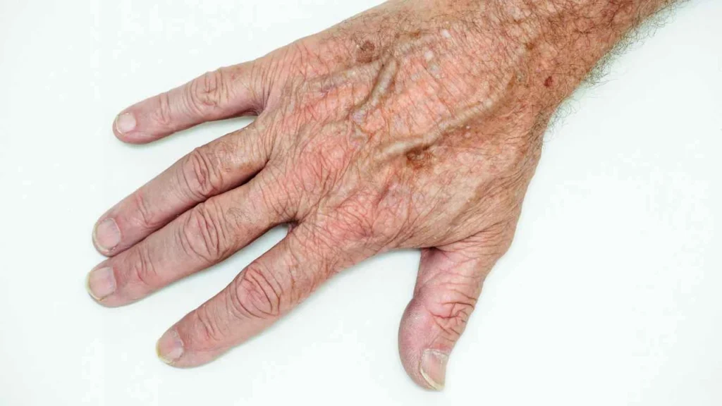 Male hand showing age spot South Kensington