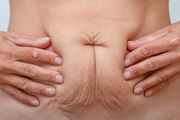Image of a woman's stomach with loose skin - example of skin tightening South Kensington options