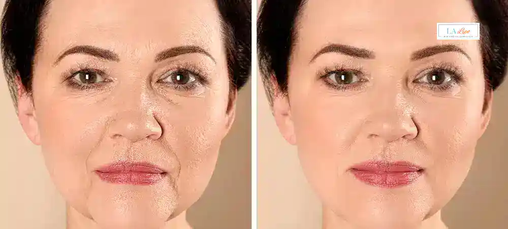 How Long Does It Take to See Results and How Long Do They Last South Kensington?