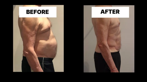 What Symptoms Can Diastasis Recti Cause in Men? Weak Core, Back Pain and Poor Posture South Kensington